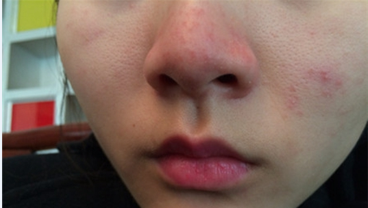 海口市治疗酒糟鼻哪里好