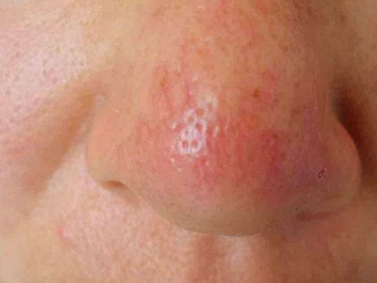 海口治疗酒糟鼻好一点的医院